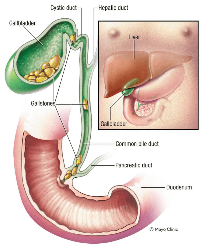What are Gallstones? Types of Gallstones?